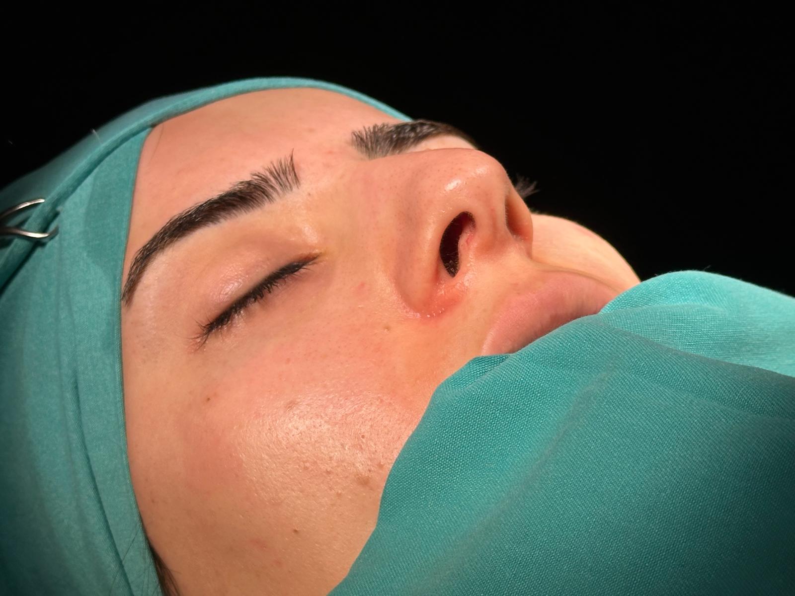 Burun estetiği öncesi ve sonrası - Vaka 1 - Op. Dr. Hasay Guliyev