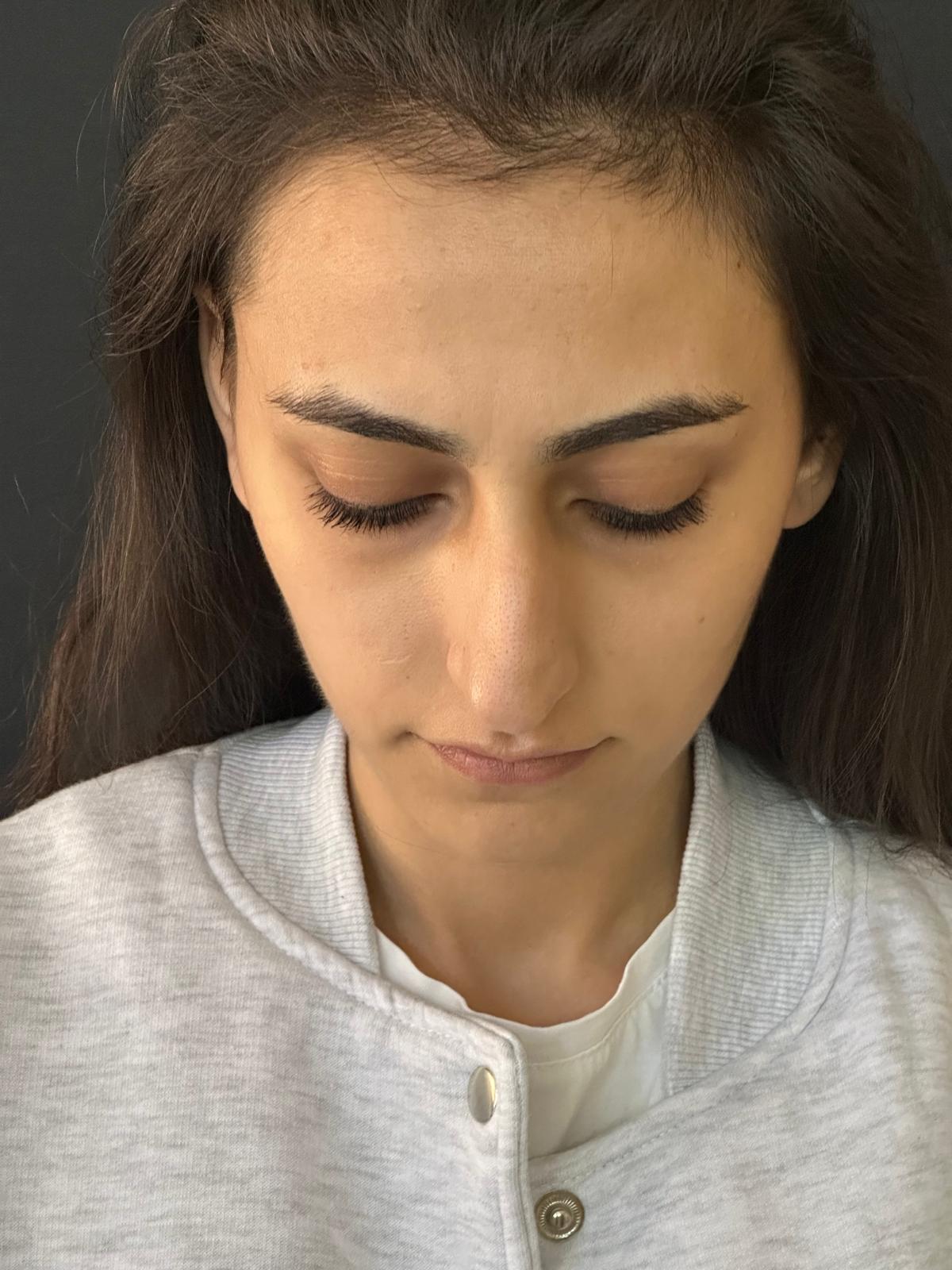 Burun estetiği öncesi ve sonrası - Vaka 5 - Op. Dr. Hasay Guliyev